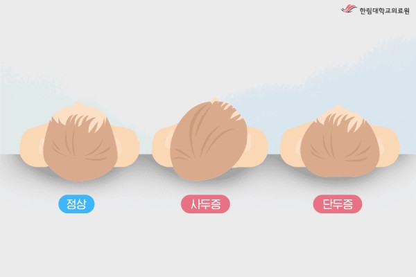 [그림] 영유아의 두개골 변형 유형